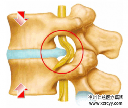 【脊柱】腰突不看年齡，生活習慣是關(guān)鍵！