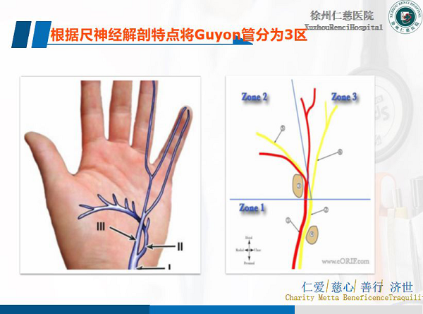 腕尺管綜合征