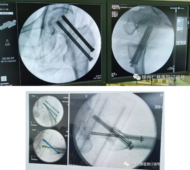 徐州仁慈醫(yī)院骨科機(jī)器人