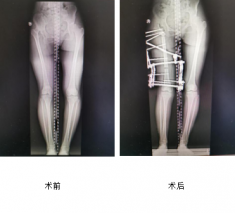 花季少女跛行15年，仁慈骨科利用Ilizarov技術(shù)幫其健康行走