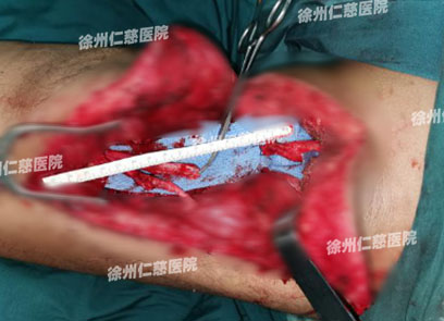 徐州仁慈醫(yī)院臂叢神經
