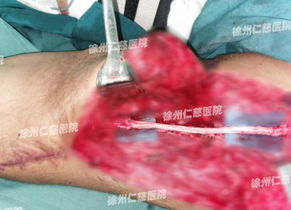 徐州仁慈醫(yī)院臂叢神經