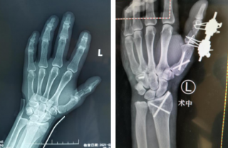 男子被鐵器砸傷，左手五處骨折，骨科機(jī)器人、腕關(guān)節(jié)鏡同上手術(shù)臺