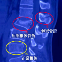 天璣骨科機(jī)器人輔助骨科微創(chuàng)手術(shù) 5個“小孔”修復(fù)腰椎骨折